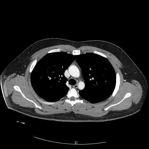 Bronchial carcinoid tumor (Radiopaedia 78272-90875 A 37).jpg