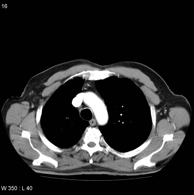 Bronchial carcinoid tumor with right lower lobe collapse (Radiopaedia 29060-29422 A 15).jpg