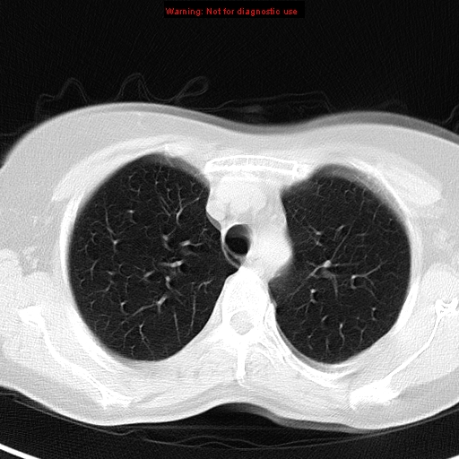 File:Bronchoalveolar carcinoma (BAC) (Radiopaedia 13436-13392 Axial lung window 12).jpg