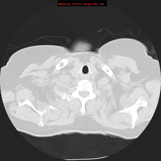 Bronchoalveolar carcinoma (Radiopaedia 13224-13233 Axial lung window 3).jpg