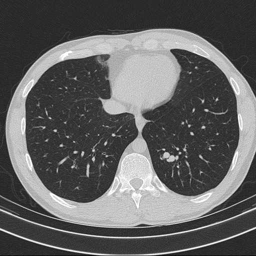 Bronchocele (Radiopaedia 60676-68429 Axial lung window 54).jpg