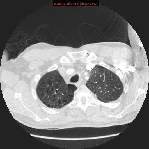 File:Bronchogenic carcinoma brain metastasis (Radiopaedia 9286-105832 Axial lung window 31).jpg