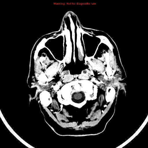 File:Bronchogenic carcinoma brain metastasis (Radiopaedia 9286-9970 B 1).jpg