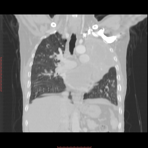 File:Bronchogenic carcinoma with left atrial large deposit - T4N3M1a (Radiopaedia 42316-45428 Coronal lung window 9).jpg