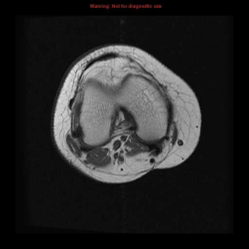 File:Brown tumor (Radiopaedia 12318-12597 Axial T1 7).jpg