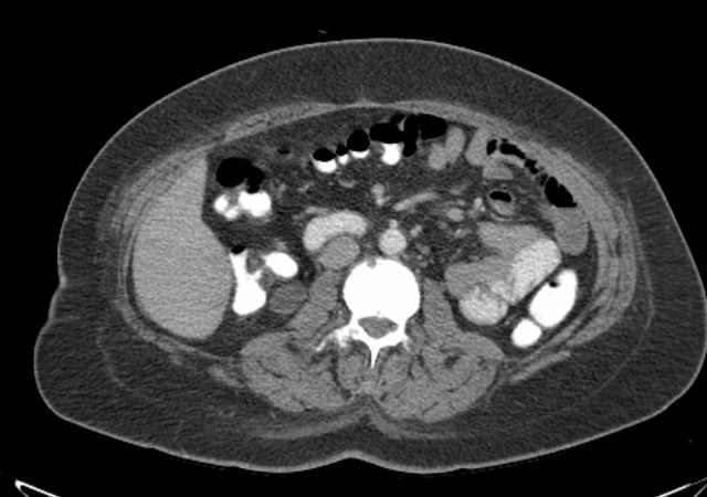 File:Brown tumors compressing the spinal cord (Radiopaedia 68442-77988 E 57).jpg