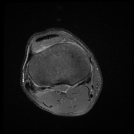 File:Bucket handle tear - medial meniscus (Radiopaedia 69245-79026 Axial PD fat sat 15).jpg