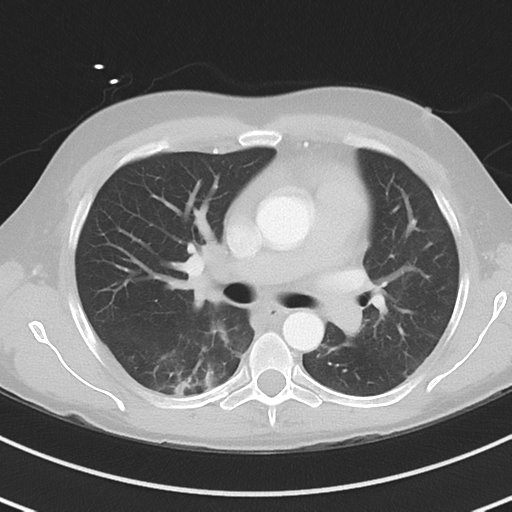 Burkitt lymphoma (Radiopaedia 34686-36121 Axial lung window 22).png