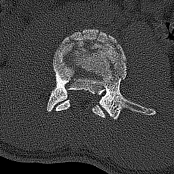 File:Burst fracture (Radiopaedia 53373-59357 Axial bone window 31).jpg