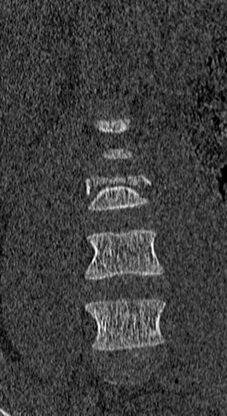 File:Burst fracture (Radiopaedia 53373-59357 Coronal bone window 11).jpg