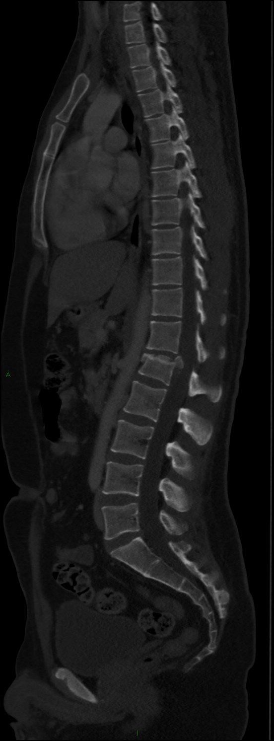 Burst fracture (Radiopaedia 83168-97542 Sagittal bone window 69).jpg