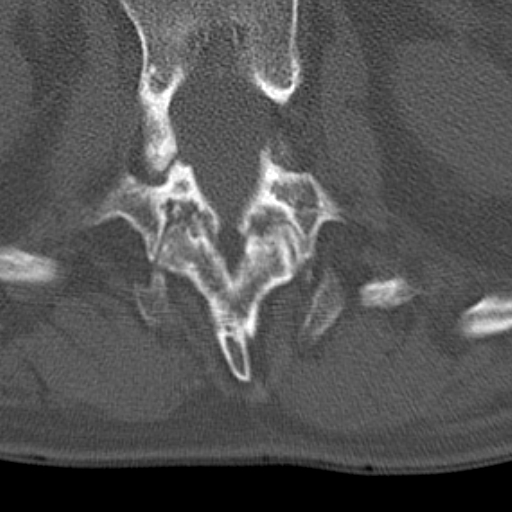 Butterfly vertebrae with kyphoscoliosis (Radiopaedia 14257-14133 Axial bone window 70).jpg