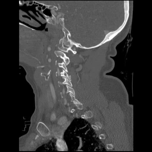File:C1 anterior arch (plough) fracture - type 1 (Radiopaedia 76181-87720 Sagittal bone window 72).jpg