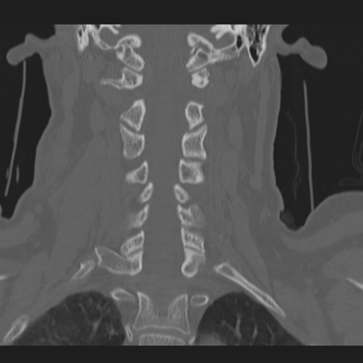 File:C2 fracture (Radiopaedia 34091-35341 Coronal bone window 29).png