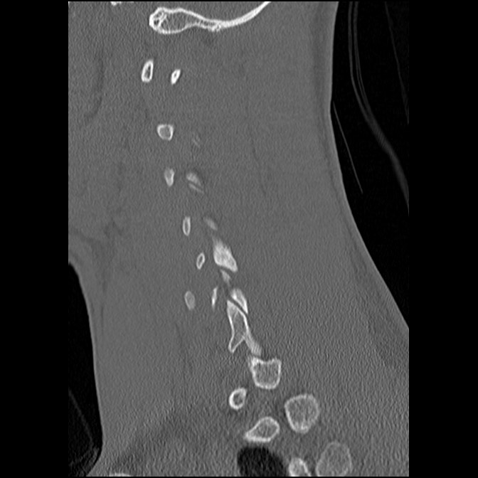 C5 facet fracture (Radiopaedia 58374-65499 Sagittal bone window 24).jpg