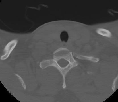 C7 laminar fracture and Klippel-Feil syndrome (Radiopaedia 86710-102850 Axial bone window 63).jpg