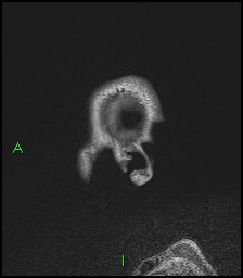 CNS manifestations of NF1 - optic pathway glioma, neurofibroma, dural ectasia (Radiopaedia 37874-39805 Sagittal FLAIR 6).jpg