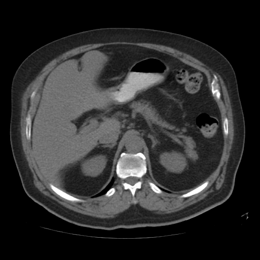 File:Calcified hepatic hydatid cyst (Radiopaedia 18907-18853 Axial non-contrast 16).jpg