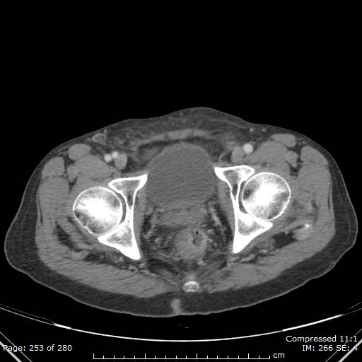 Calcified liver metastases (Radiopaedia 44699-48470 B 61).jpg