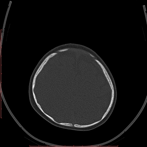 Calcified middle cerebral artery embolism (Radiopaedia 78949-91860 Axial bone window 61).jpg