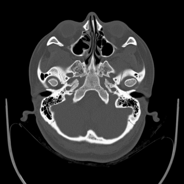 Calvarial osteoma (Radiopaedia 36520-38079 Axial bone window 20).jpg