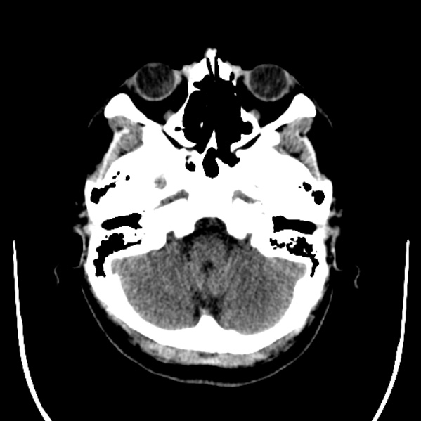 Calvarial osteoma (Radiopaedia 36520-38079 Axial non-contrast 11).jpg