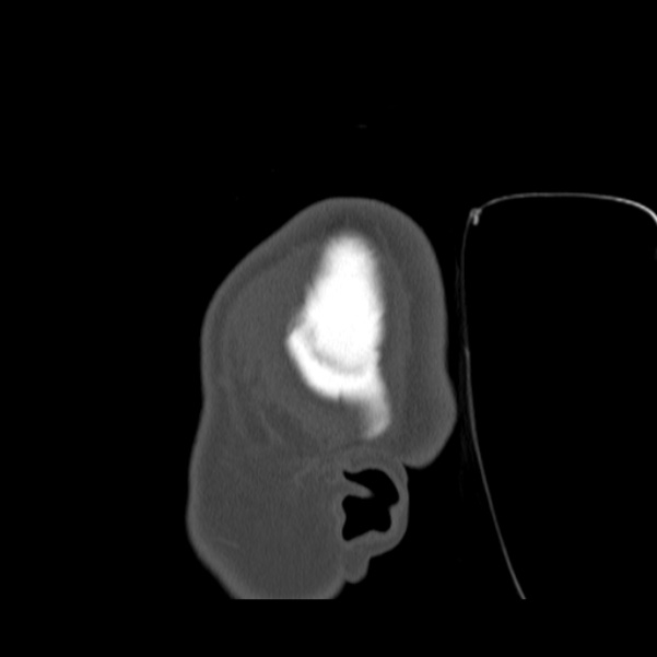 Calvarial osteoma (Radiopaedia 36520-38079 Sagittal bone window 7).jpg