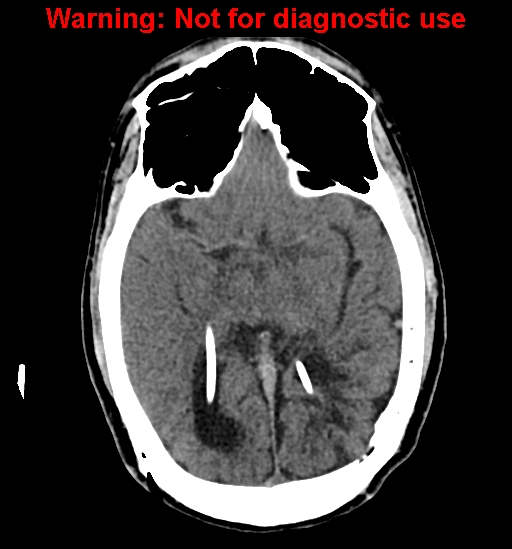 File:Calvarial thickening from chronic shunting (Radiopaedia 60079-67637 Axial non-contrast 15).jpg