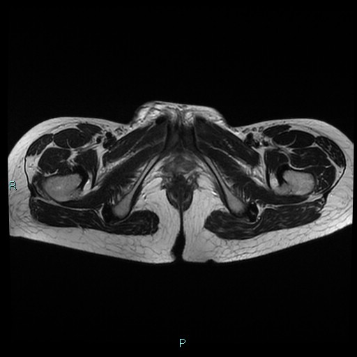 File:Canal of Nuck cyst (Radiopaedia 55074-61448 Axial T2 22).jpg