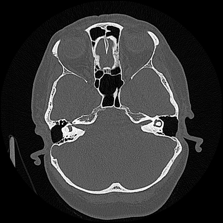 Canal up mastoidectomy (Radiopaedia 78108-90638 Axial bone window 84).jpg