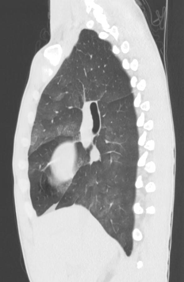 Cannabis-induced diffuse alveolar hemorrhage (Radiopaedia 89834-106946 Sagittal lung window 55).jpg