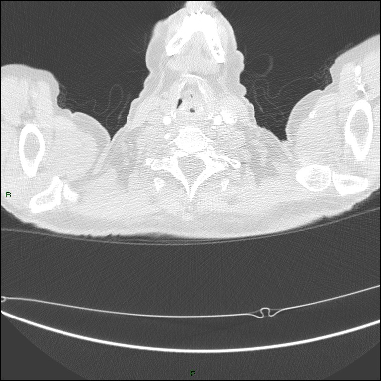 Cannonball metastases (Radiopaedia 82110-96150 Axial lung window 6).jpg
