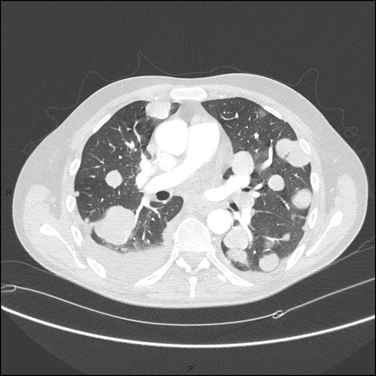Cannonball metastases (Radiopaedia 82110-96150 Axial lung window 97).jpg