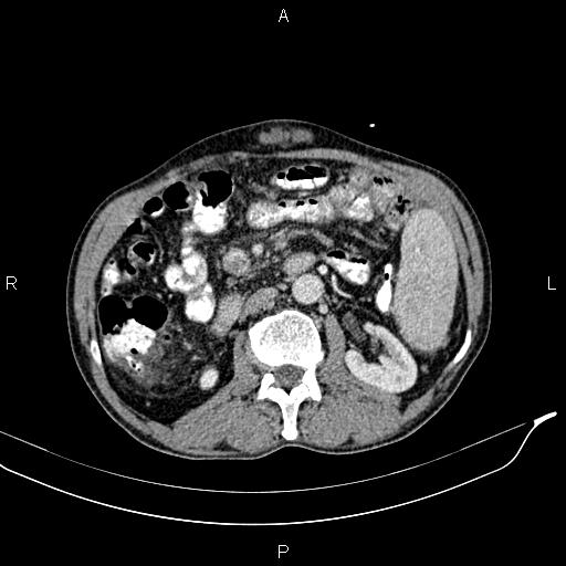 File:Caput medusae sign - portal hypertension (Radiopaedia 64007-72759 A 41).jpg