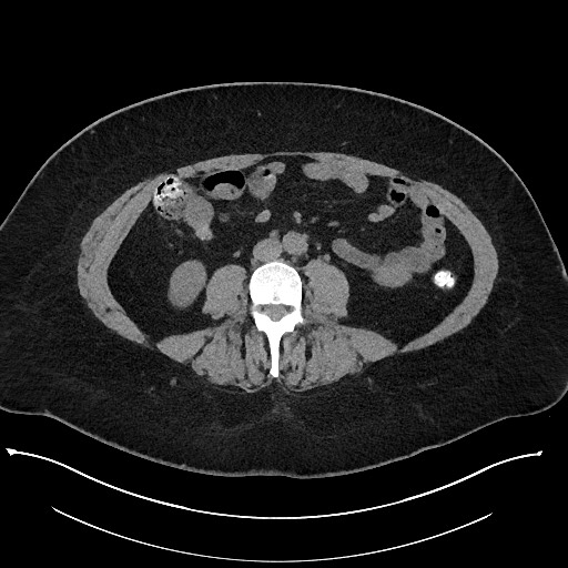 Carcinoid tumor - terminal ileum (Radiopaedia 60931-68740 Axial non-contrast 64).jpg