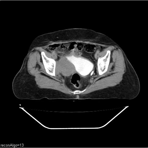 File:Carcinoma cervix- recurrence (Radiopaedia 34702-36137 Axial C+ delayed 22).jpg