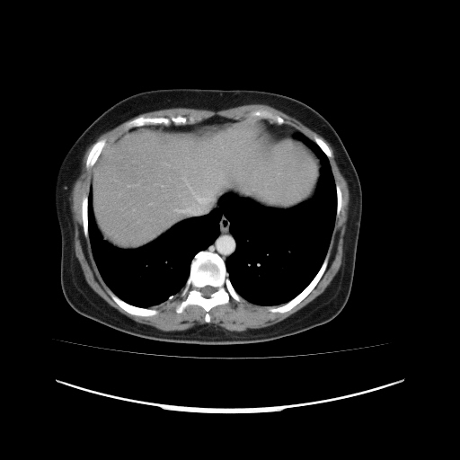 File:Carcinoma colon - hepatic flexure (Radiopaedia 19461-19493 A 16).jpg