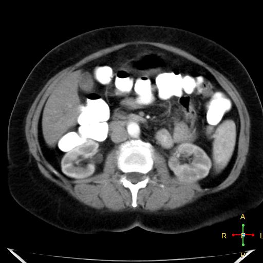 File:Carcinoma of sigmoid colon (Radiopaedia 23071-23100 C+ arterial phase 11).jpg
