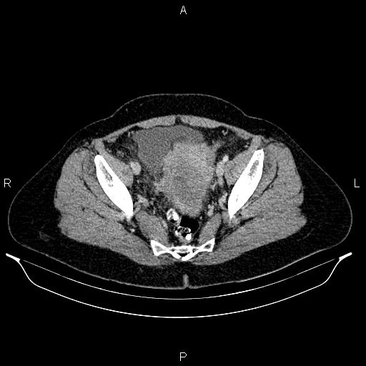 Carcinoma of uterine cervix (Radiopaedia 85861-101700 A 68).jpg