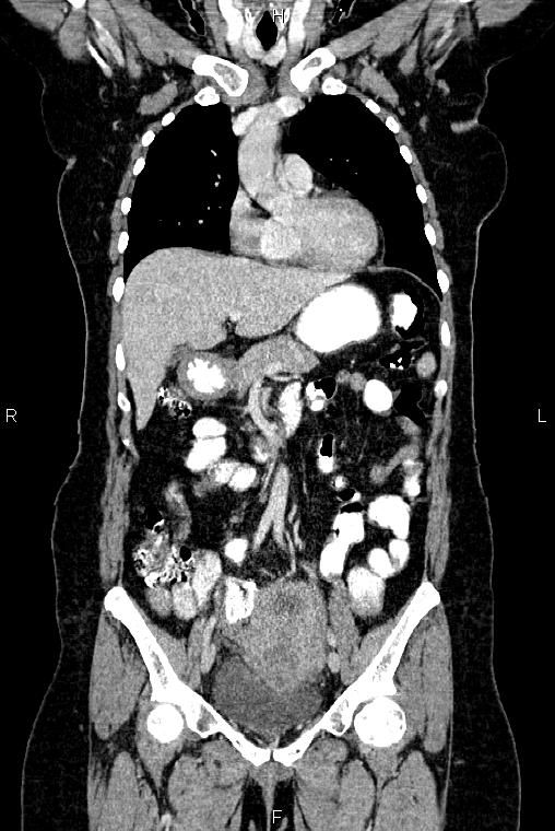 Carcinoma of uterine cervix (Radiopaedia 85861-101700 C 20).jpg