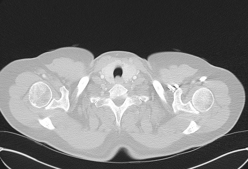 Cardiac sarcoidosis (Radiopaedia 74548-85534 Axial lung window 1).jpg