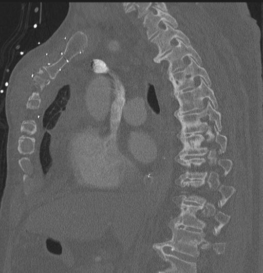 Cardiac trauma (Radiopaedia 32874-33858 Sagittal bone window 52).jpg