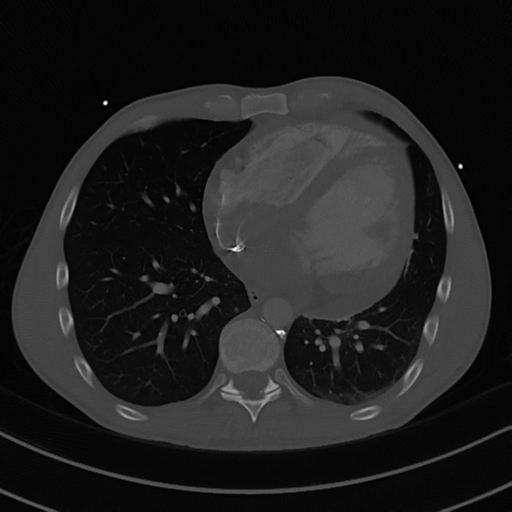 Cardiac tumor - undifferentiated pleomorphic sarcoma (Radiopaedia 45844-50134 Axial bone window 45).png