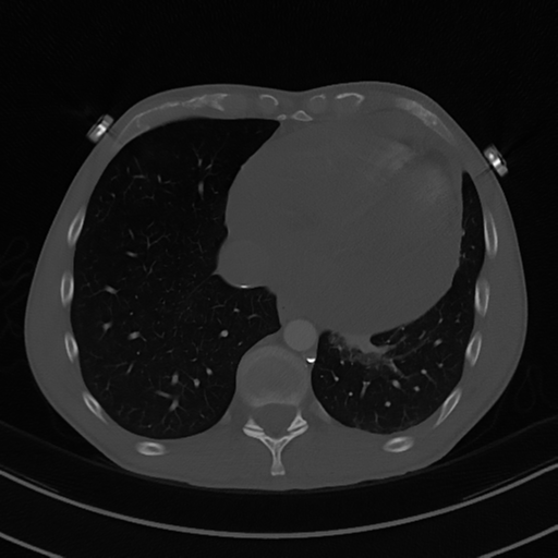 File:Cardiac tumor - undifferentiated pleomorphic sarcoma (Radiopaedia 45844-50134 Axial bone window 52).png