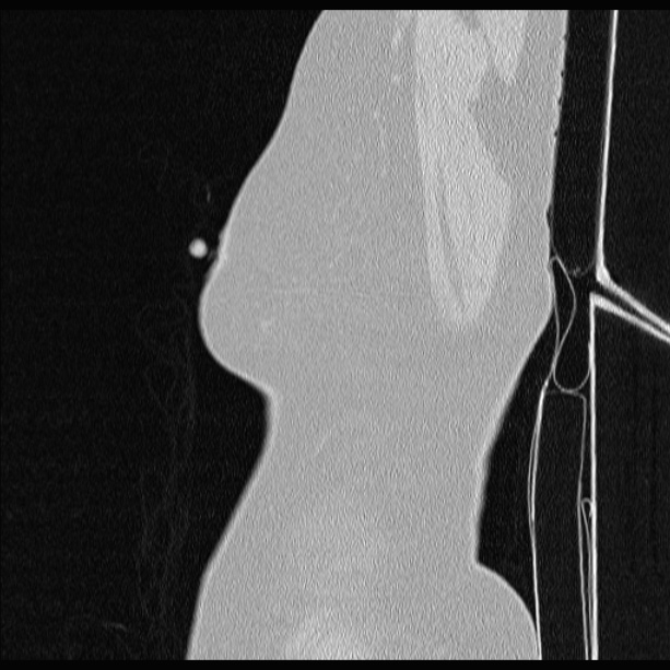 Cardiogenic pulmonary edema (Radiopaedia 29213-29609 Sagittal lung window 1).jpg
