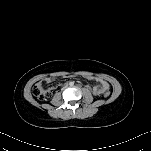 Caroli disease with medullary sponge kidney (Radiopaedia 82622-96804 C 41).jpg