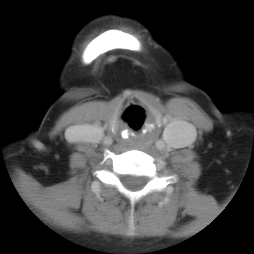 Carotid body tumor (paraganglioma) (Radiopaedia 38586-40729 A 23).jpg
