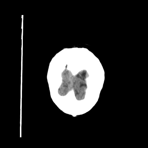 Carotid near-occlusion (Radiopaedia 85304-100887 Coronal non-contrast 70).jpg