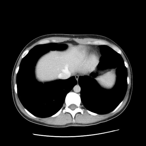 Castleman disease with fibrous pseudotumor in the abdomen (Radiopaedia 77296-89373 A 14).jpg