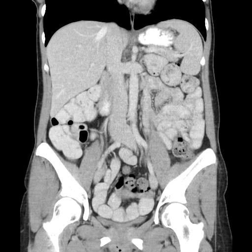 Castleman disease with fibrous pseudotumor in the abdomen (Radiopaedia 77296-89373 B 47).jpg